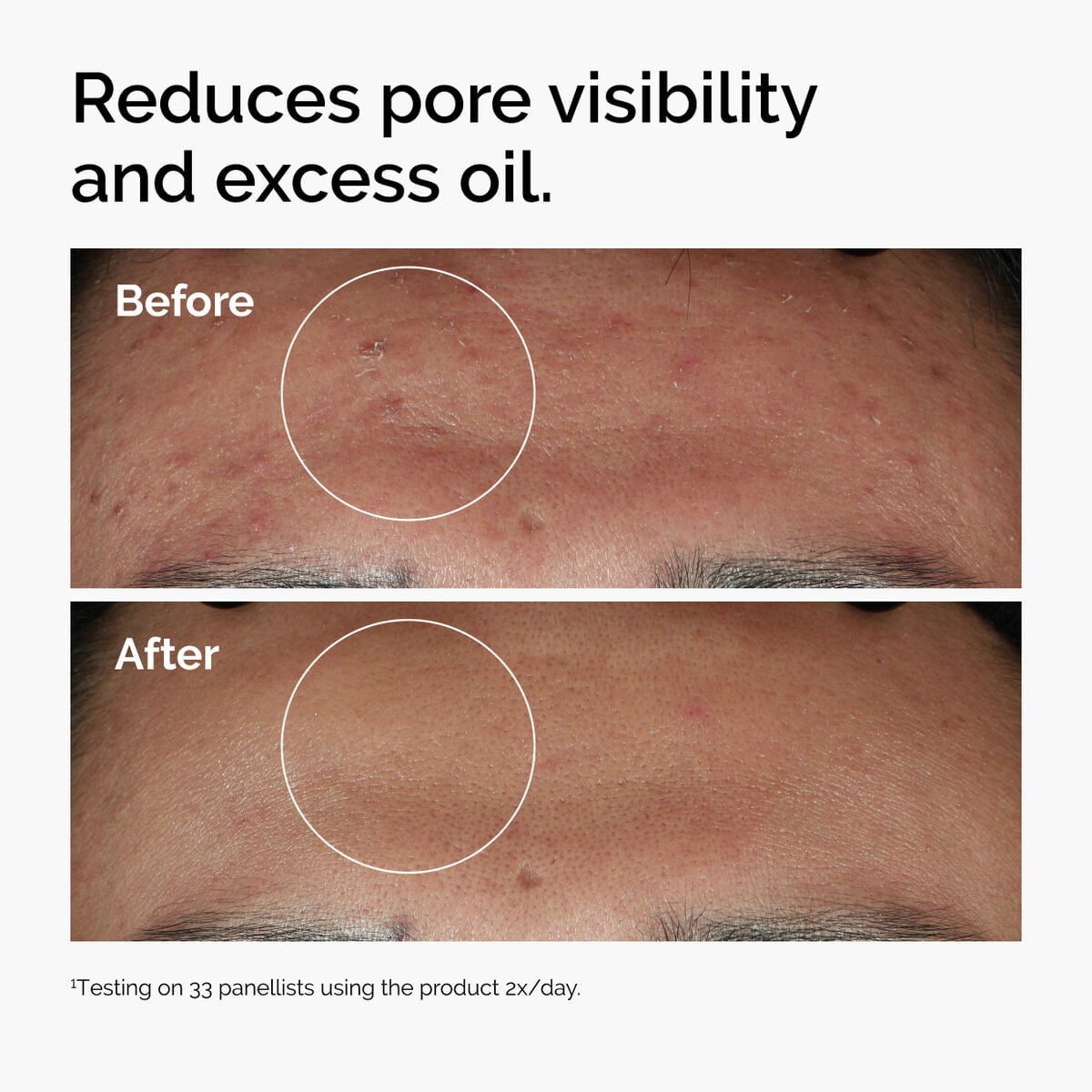 niacinamide-10-zinc-1-c9 ord-niacinamide-zinc-blemish-serum-before-after-pores.jpg