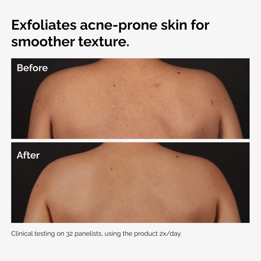 the-body-care-collection-v3 ord-salicylic-acid-body-serum-before-after-graphic-NA.jpg