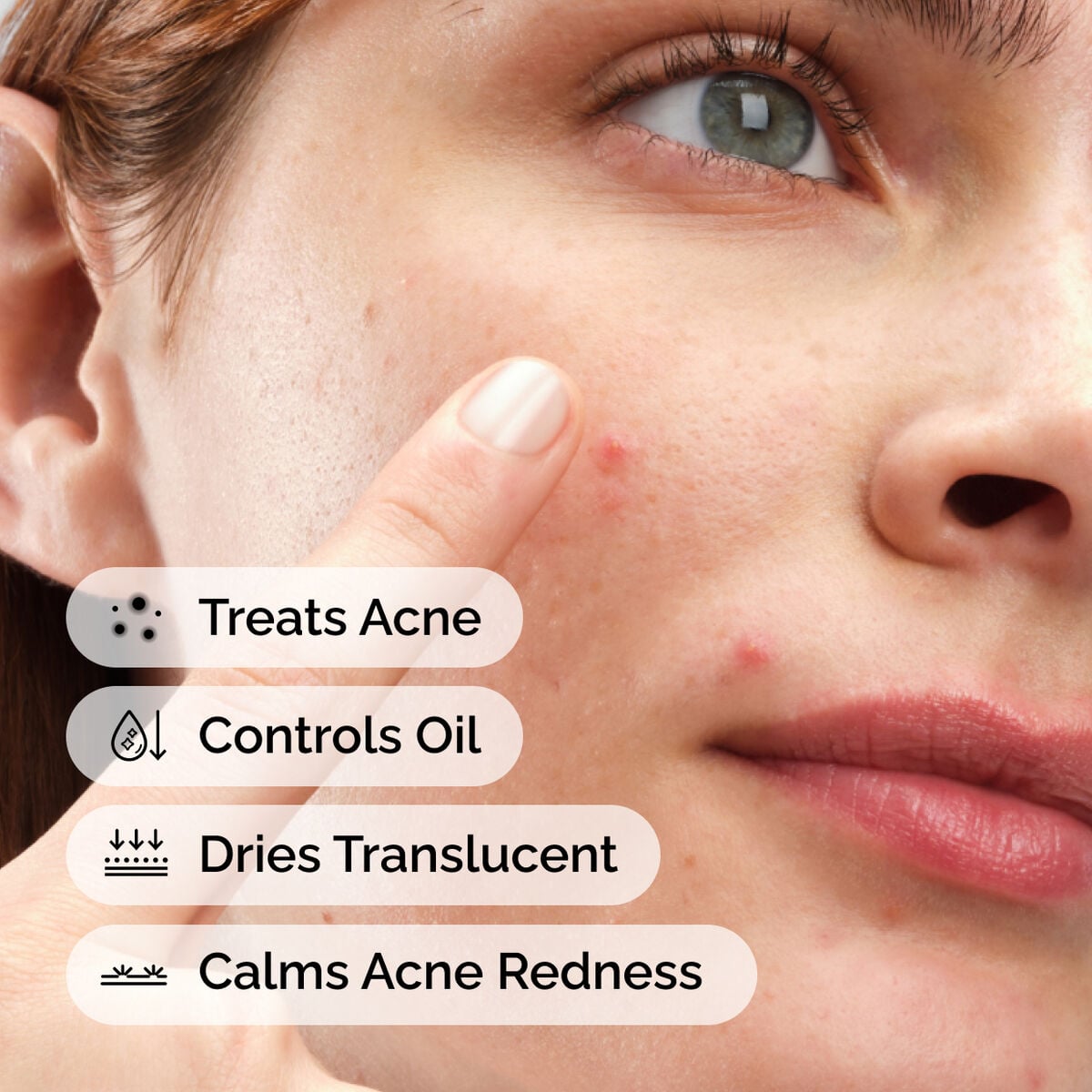 sulfur-10-powder-to-cream-concentrate-m7 ord-sulfur-10pct-powder-to-cream-concentrate-model-application-with-benefits-acne.jpg